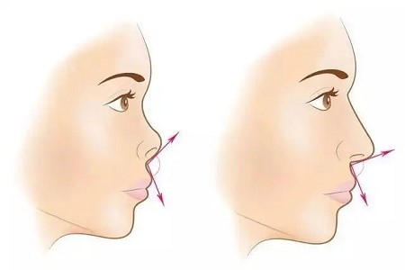 肉鼻子和蒜头鼻有什么区别